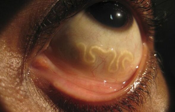 Loa The loa worm lives in the human eye and causes blindness